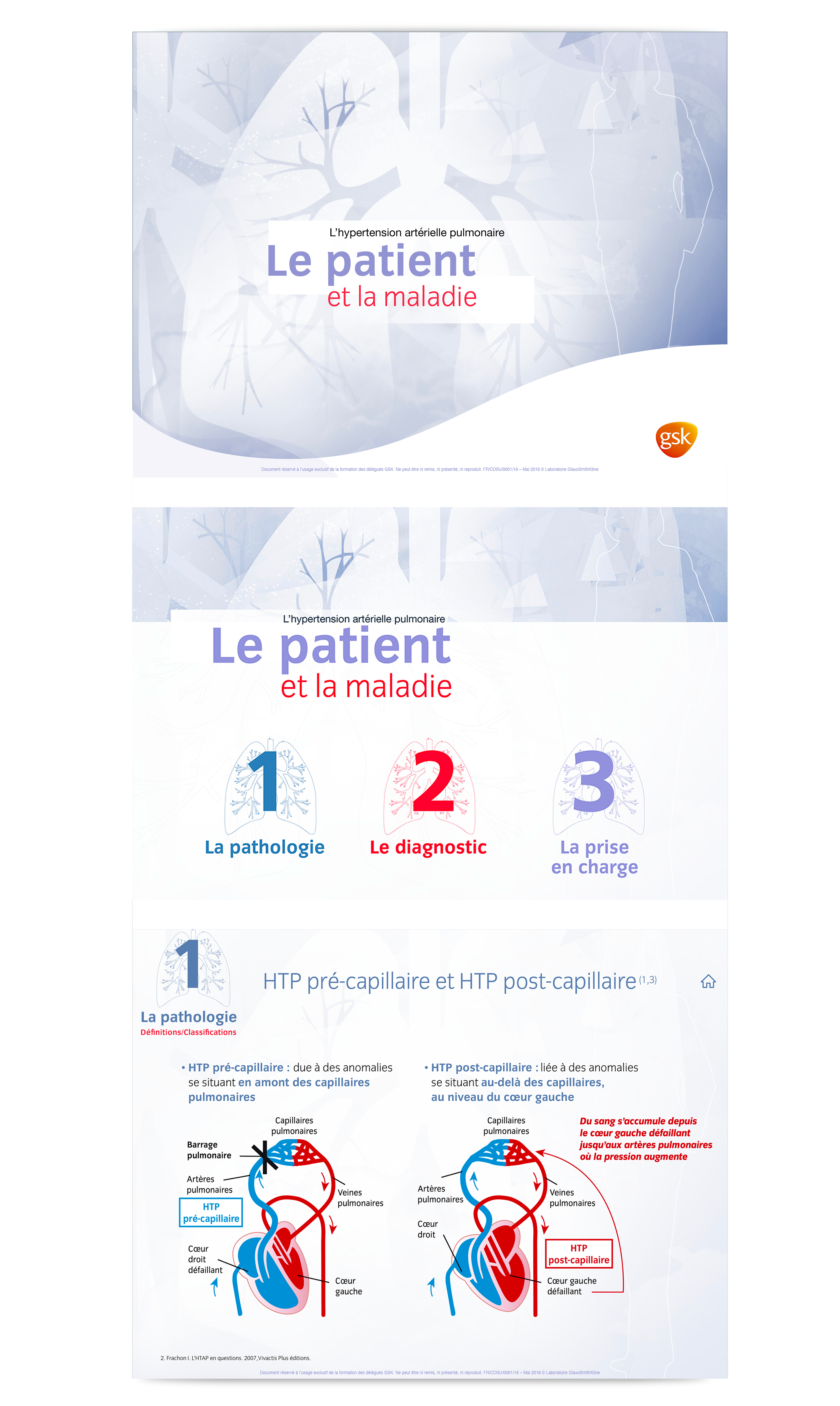 image slide kit l'hyper tension pulmonaire